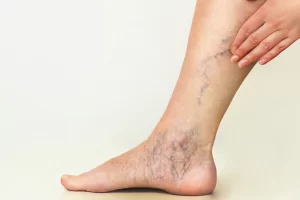 Advanced Spider Vein Treatments at the Center for Vein Wellness in Beverly Hills