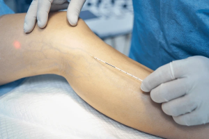 Exploring Varicose Vein Treatment Options: From Simple to Surgical