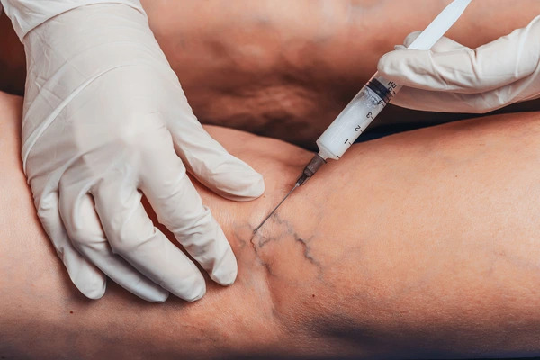 cosmetic vein treatment